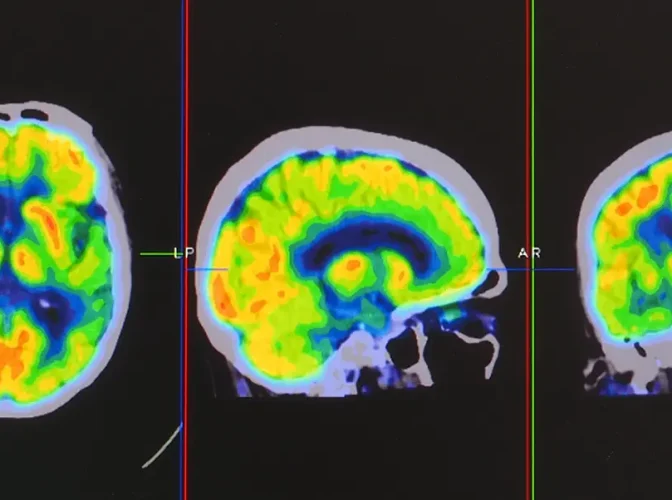 Positron emission tomography or PET images showing many phase of brain perfusion function and activity