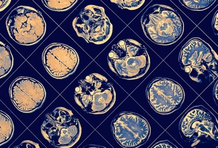 MR image of human brain