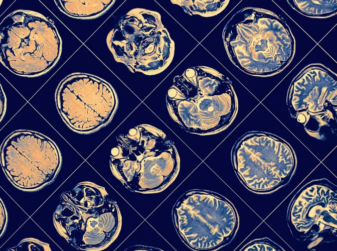 MR image of human brain